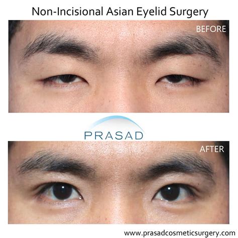 Double Eyelid Surgery Before and After Photos | Dr Amiya Prasad