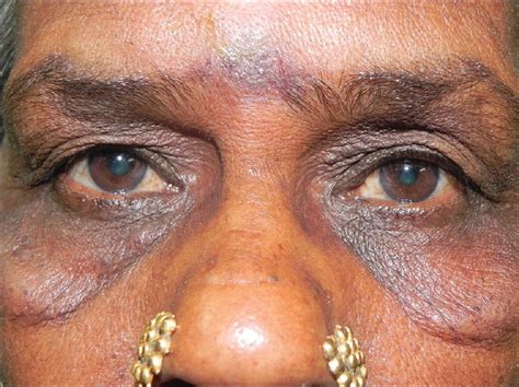 Spectrum of periorbital dermatoses in South Indian population - Indian ...