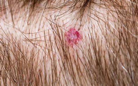 Scalp Folliculitis: Causes, Symptoms & Ayurvedic Remedies – Vedix