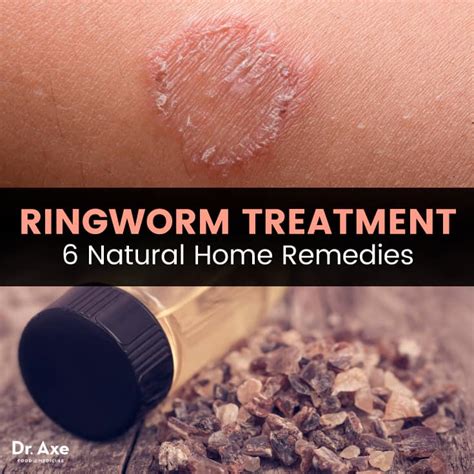 Ringworm Treatment: 6 Natural Remedies + How to Prevent It | Best Pure ...