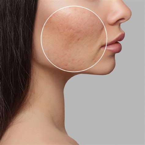 ACNE SCARS - Types of Acne Scars And Acne Scars Treatment - Ecosh