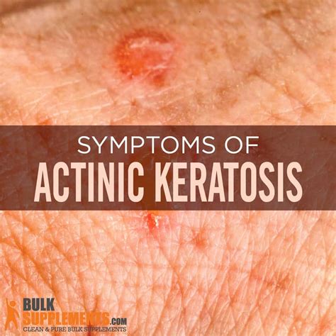 Skin Cancer Actinic Keratosis Hand