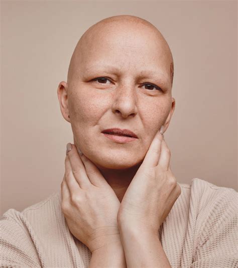 Alopecia Totalis – Causes, Symptoms, Treatment, And Risks