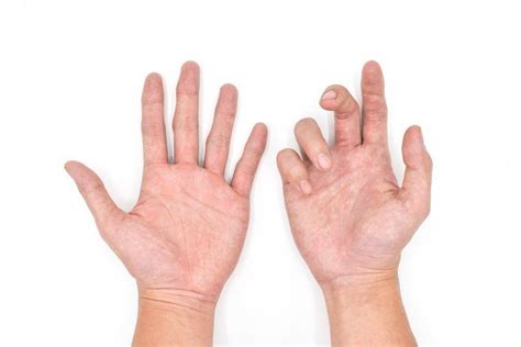 Dupuytren's Contracture: Overview, Symptoms, Causes, Treatment and ...