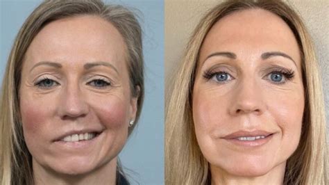 Get Facial Paralysis Treatment | Cleveland Clinic