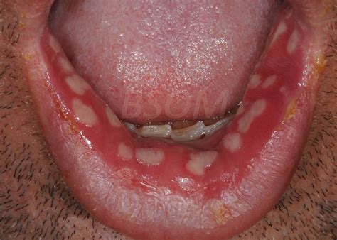 Herpes Symptoms In Mouth