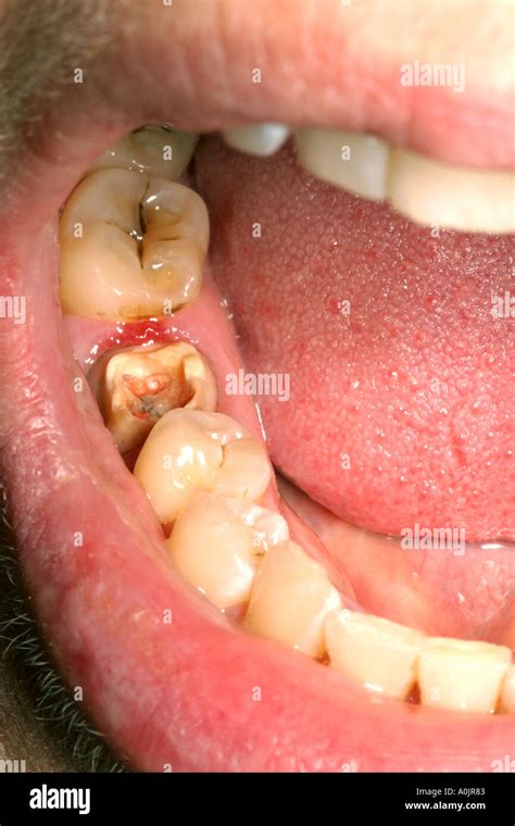 Broken tooth Stock Photo - Alamy