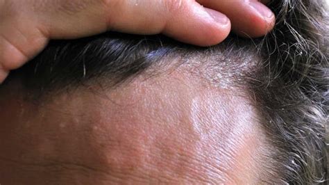 Management of Scalp Psoriasis | 1mhealthtips.com