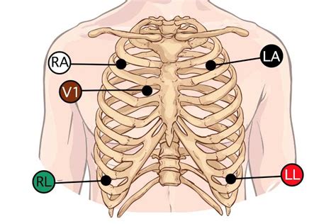 5-Lead ECG Placement and Cardiac Monitoring | Ausmed