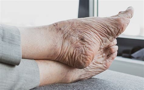 Aging Feet Changes and Common Problems