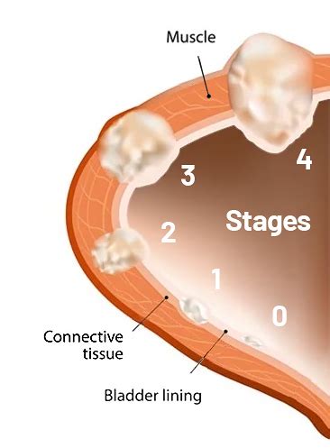 Bladder Cancer: Causes, Signs, Symptoms, Diagnosis and Stages | Saint ...