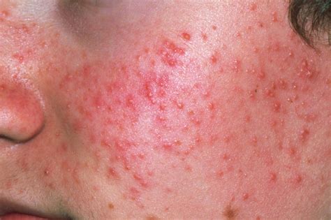 Acne is a common skin condition that affects most people at some point.