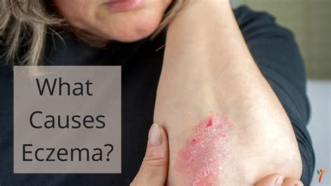 Does Eating Gluten Cause Eczema? - Health Yeah Life