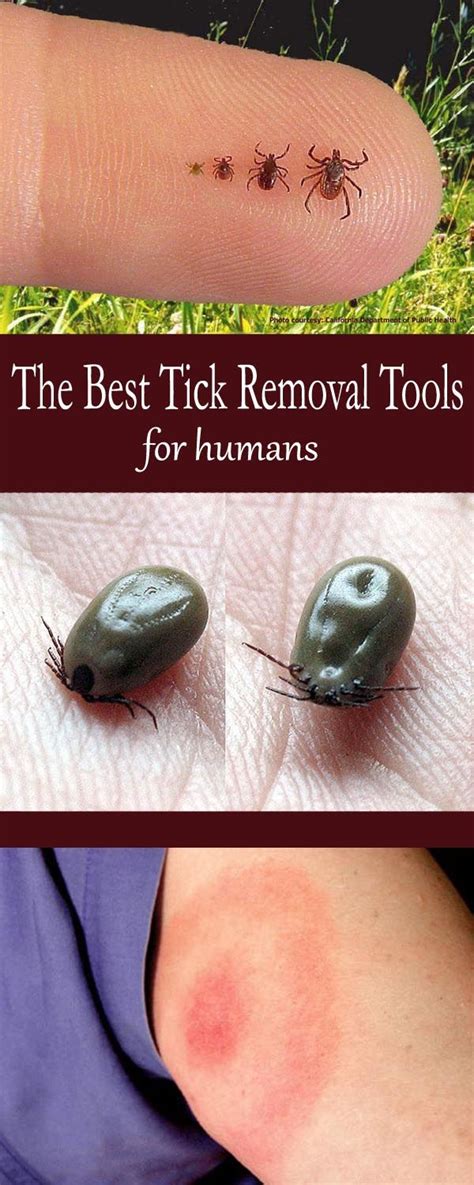 How To Remove A Tick From A Dog When The Head Is Embedded - HOWTOMREOV