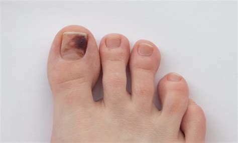 Melanoma under toenail pictures: black spot, nail melanoma pictures ...