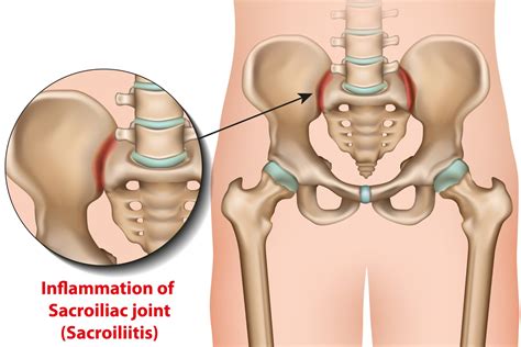 Sacroiliac Joint Dysfunction Causes, Symptoms & Treatment | Advanced ...