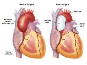 dilated ascending thoracic aorta - Yahoo Image Search Results | Aortic ...