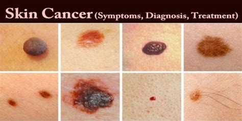 Skin Cancer Signs Treatment : Melanoma Symptoms Pictures Causes And ...