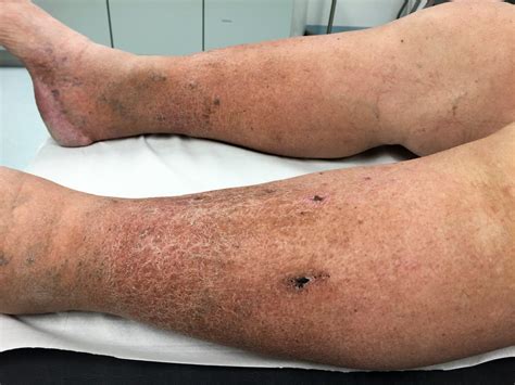 Skin Changes With Veins | Gold Coast Varicose Vein Clinic - Laurel Clinical