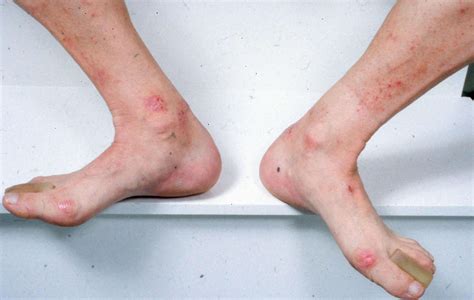 Skin Rash On Ankle