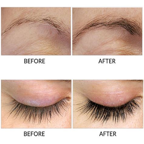 Diy Eyelash Growth Serum Before And After - Health Secrets: Latisse an ...