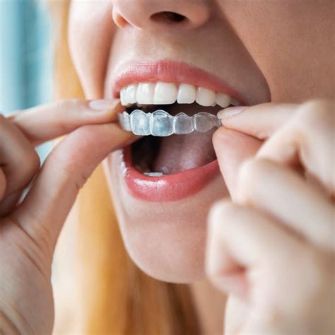 The Pros and Cons of At-Home Teeth Aligners, According to a Dentist ...