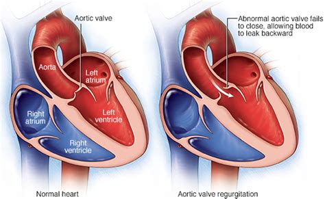 Mitral Valve Prolapse With Regurgitation