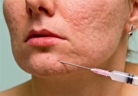 Atrophic scars: causes, treatment | Health 2024