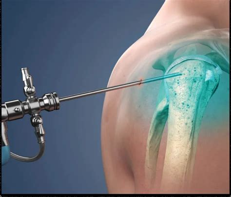 Shoulder Arthroscopic Surgery - DR. SHREEKANTHA K S RAO