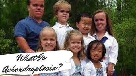 What Is Achondroplasia: Causes – Symptoms And Treatment [Scientific ...