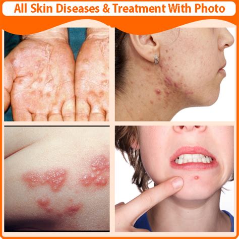 Skin Diseases and Treatment | androidrank.org