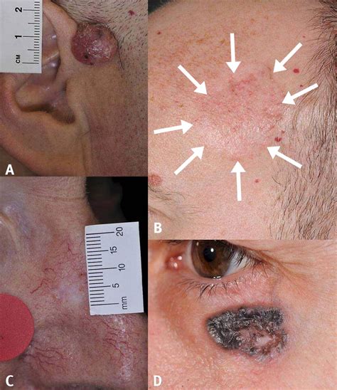 Basal Cell Skin Cancer Treatment