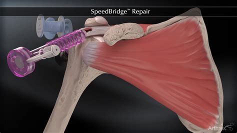 Arthrex - SpeedBridge™ Double-Row Technique