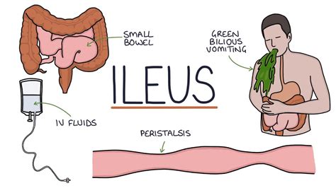 Paralytic Ileus