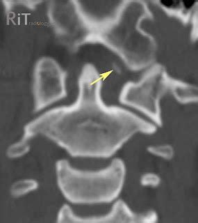 RiT radiology: Occipital Condylar Fracture