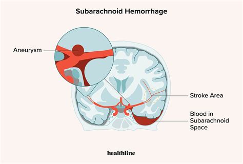 Subarachnoid Hemorrhage: Symptoms, Causes & Risk Factors in 2022 ...