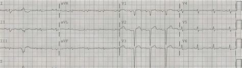 Dr. Smith's ECG Blog: Left ventricular Aneurysm Morphology Distorted by ...