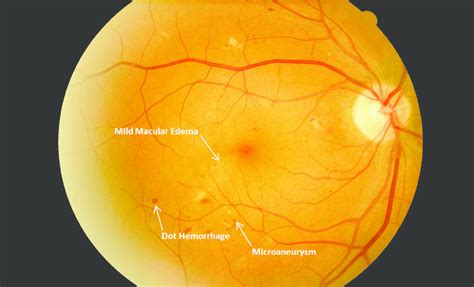 Moderate non-proliferative diabetic retinopathy with mild diabetic ...