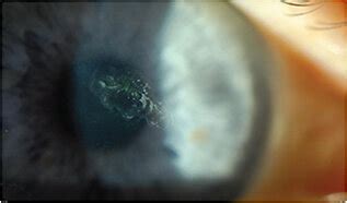 Corneal Erosion Staining