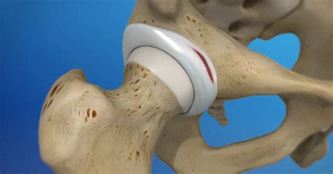 Acetabular Labrum - Understanding It's Anatomy And Function