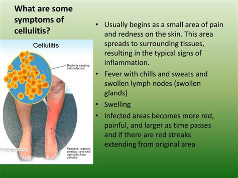 PPT - Cellulitis PowerPoint Presentation - ID:1857729