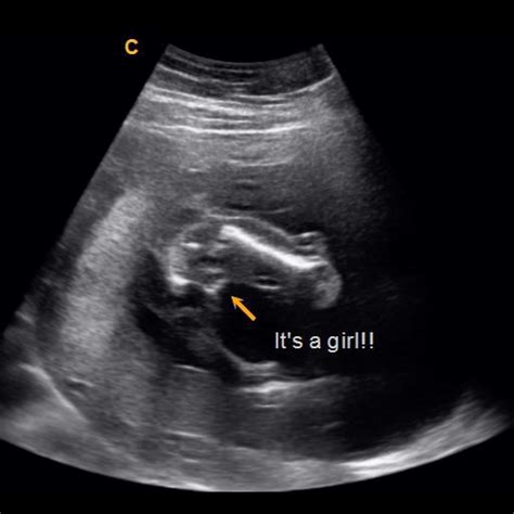 Baby At 14 Weeks 3d Ultrasound - Get More Anythink's