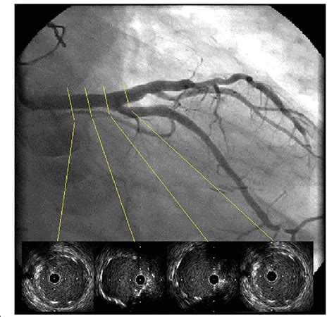 Final angiogram showing no leasions and the bare metal stent fully ...