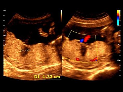 Placental Lakes | 24 wks. 4 days pregnancy || Normal pregnancy - YouTube