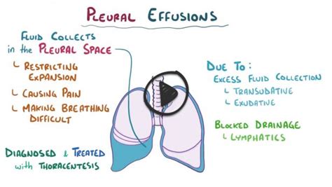 Pleural effusion (ReelDx) - Smarty PANCE