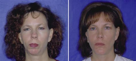 Before & After Case 23 hemifacial microsomia surgery - Larry M. Wolford ...