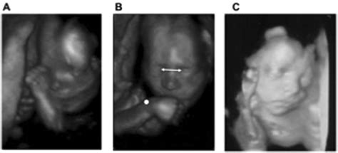 Fetal movements. Frames of ultrasound scans showing the (A) hand to ...