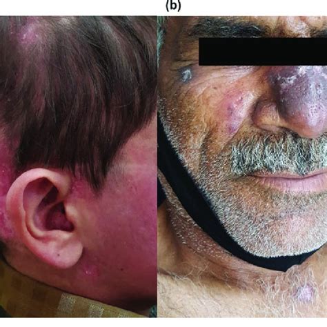 Discoid lupus erythematosus (DLE) involving the face (A) and scalp (B ...