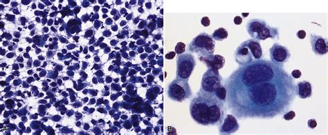 Malignant and Borderline Mesothelial Tumors of the Pleura | Clinical Gate