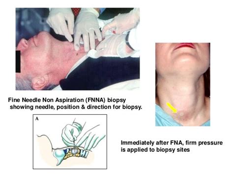 Thyroid Fna,bethesda system